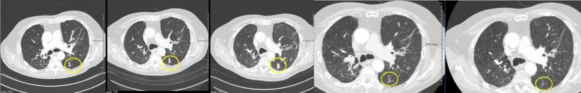 Confirmed progression in late response to therapy (from left): baseline and...