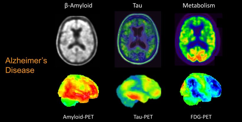 PET molecular imaging of a patient with AD Dementia. From left to right single...