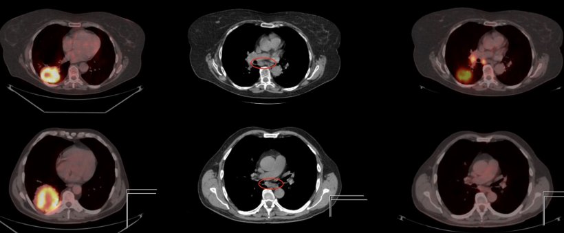 Two patients with lung cancer, both with primary tumor dorsal in the right...