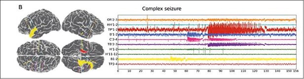 Simulation of a patient’s epileptic seizures: Seizures started in the right...