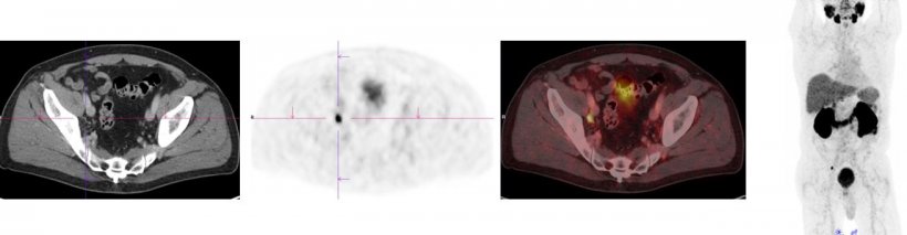 Biochemical recurrence: 67-year-old patient with prostate cancer, radical...