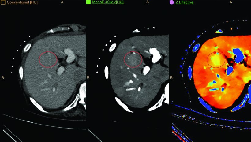 Philips IQon Spectral CT delivers multiple layers of retrospective data in a...