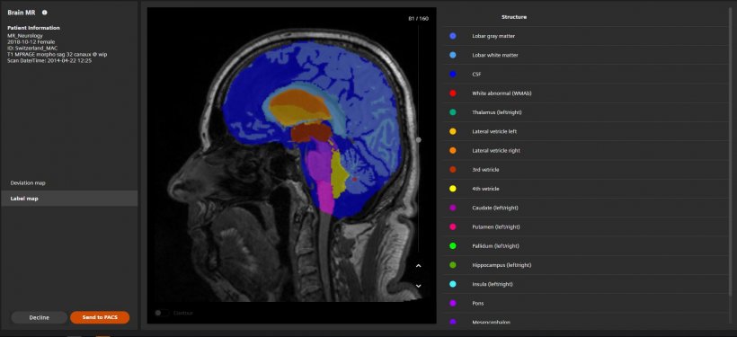 AI-Rad Companion Brain MR for Morphometry Analysis automatically segments the...