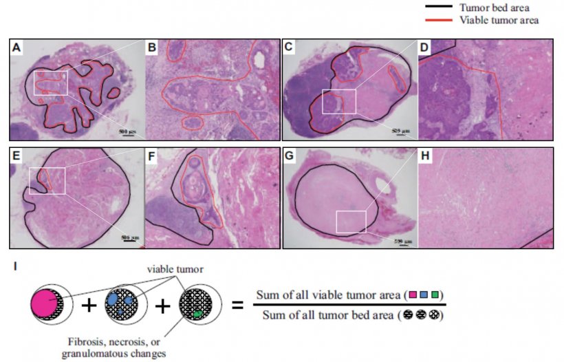 Fig.1 : Assessment of tumor regression according to LN regression grading...