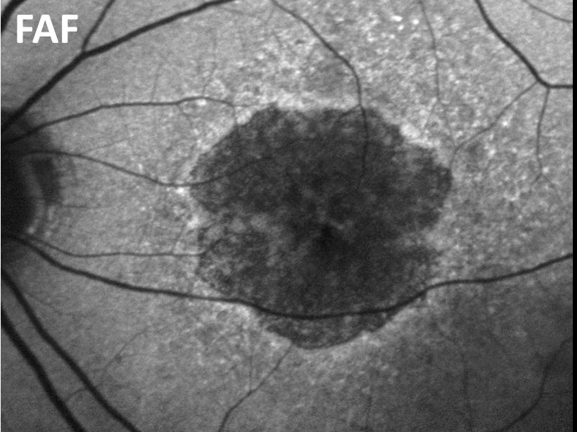 Fundus-Autofluoreszenz (FAF): Aufnahme des Augenhintergrunds bei geographischer...