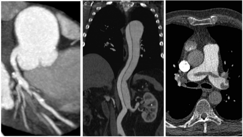 Von links nach rechts: Koronarangiopathie, Aortendissektion und Lungenembolie.