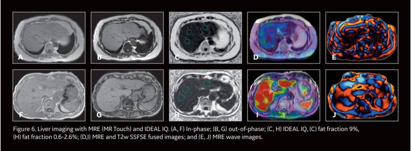 MRE plus Fib-4 prove highly accurate in liver fibrosis detection