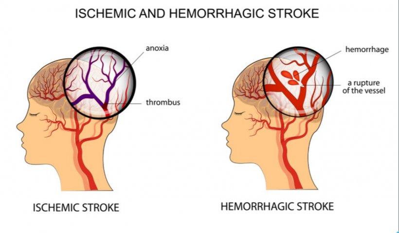 Major reduction in new strokes until 2030