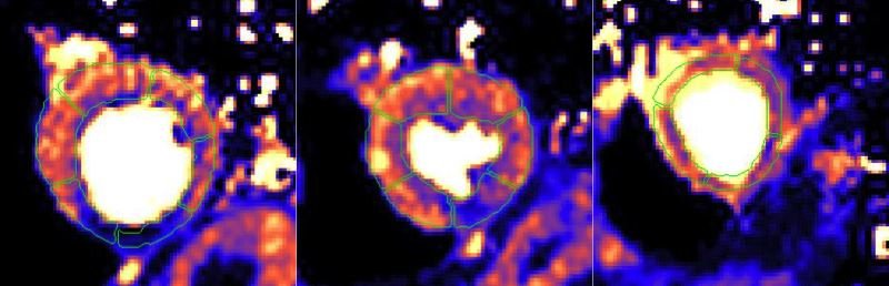 Myocardial perfusion maps for a patient with a right coronary artery stenosis....