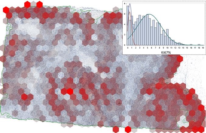 The hexagonal grid overlaid in breast cancer tissue section, stained on...