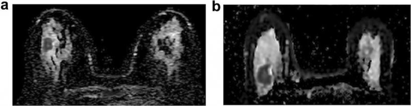 Figure 2: A: ADC map of 49-year-old patient with luminal A cancer in the right...