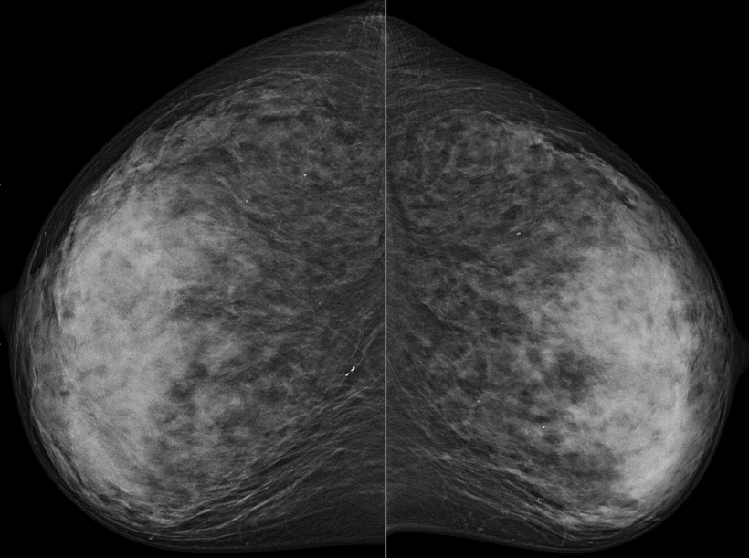 birads 2 benign findings