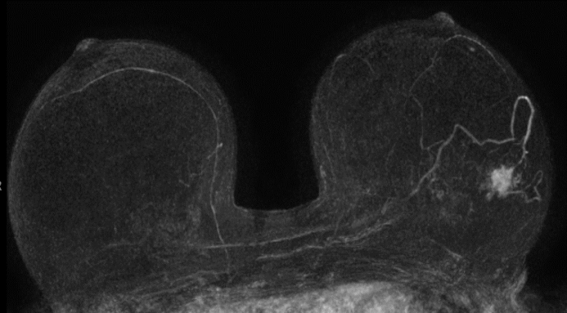 MIP of abbreviated MRI: highly suspicous findings on the left