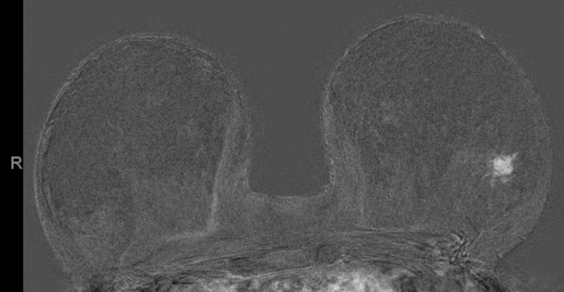 FAST (first post contrast subracted) (= single-slice): MR-BIRADS-5