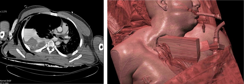 Abb.1 : Polytrauma-CT: kompletter Lungenstielabriss rechts mit massiver...