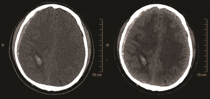 Diese CT-Aufnahme zeigt die graue und weiße Hirnsubstanz sowie ein subdurales...