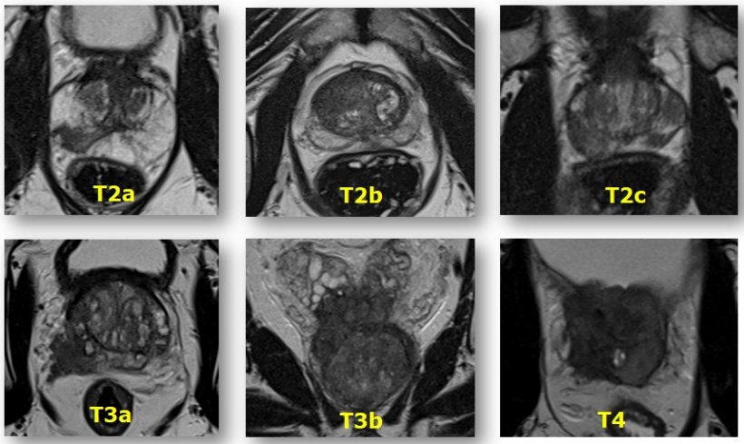 Abbildung zeigt verschiedene T-Stadien von Prostata-Karzinomen im MRT (lokales...