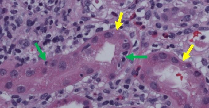 Microscopic image of kidney tubules (yellow arrows) under an immune attack...