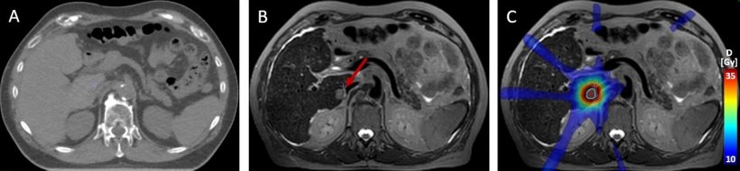 MR-guided high precision radiotherapy of a liver metastasis. (A) Native...