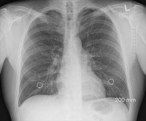 Lungenröntgen: Fibrose verhärtet das Gewebe.
