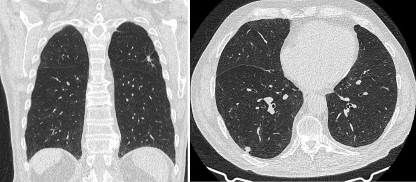 Left image: Left upper lobe lung nodule identified at ultra-low dose CT...