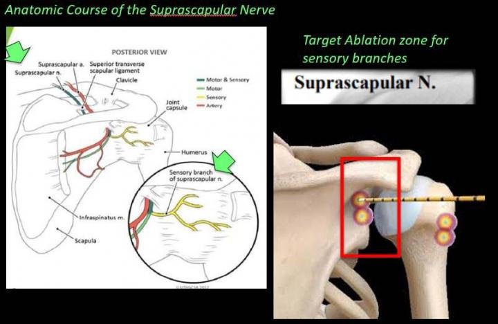 Suprascapular nerve cooled radiofrequency ablation targets.