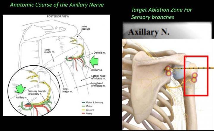 Axillary nerve cooled radiofrequency ablation: ablation targets.