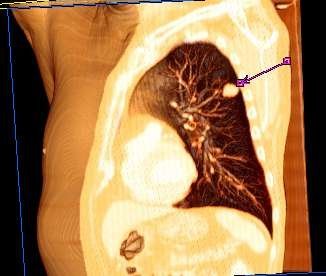 3D Volume Rendering einer Lunge mit Bronchialkarzinom. Der Pfeil zeigt auf den...