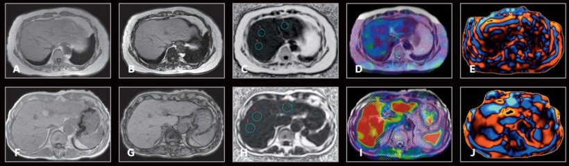 Liver imaging with MRE (MR Touch) and IDEAL IQ. (A,F) In-phase; (B,G)...