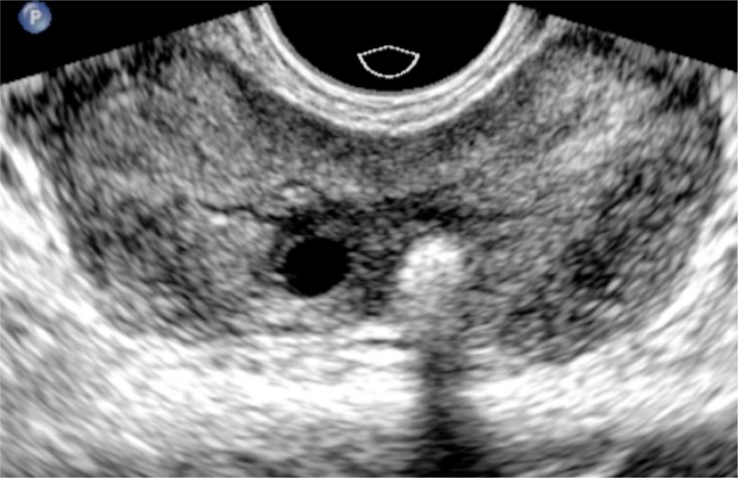 Azoospermia caused by obstruction at the level of the ejaculatory ducts. The...