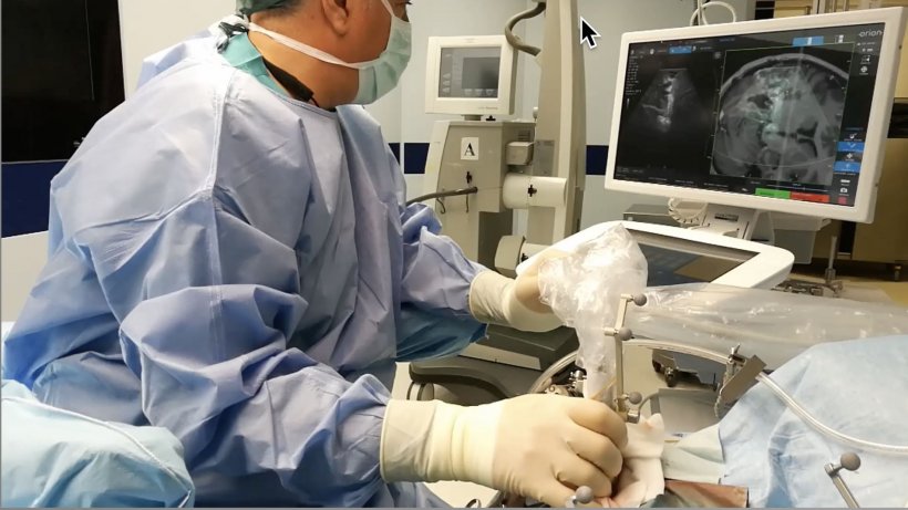 Benefits of ultrasound in neurosurgical oncology