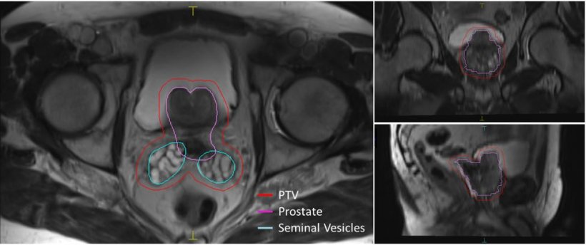 Deep learning boost for prostate cancer workflow