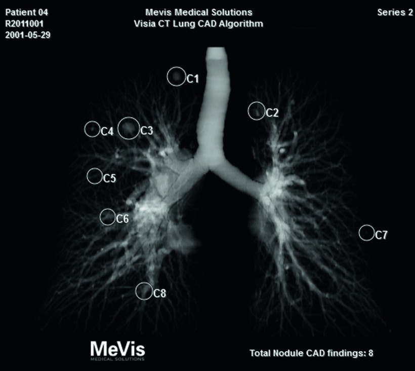 Temporärer Vergleich von Bilddaten mit MeVis Visia LungCAD.