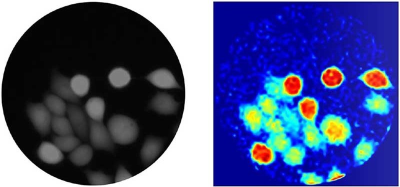 Left: conventional microscope image of fluorescently labelled cancer cells....