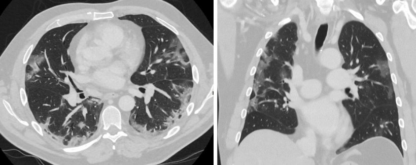 CT scans of Covid-19 patient