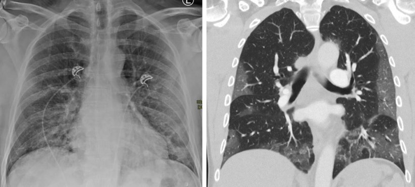 Radiography vs. CT scan of the same Covid-19 patient