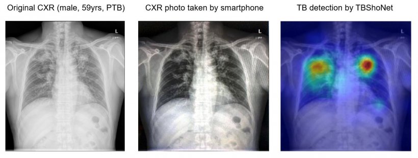 UPDATE: Covid-19 and lung infections imaging