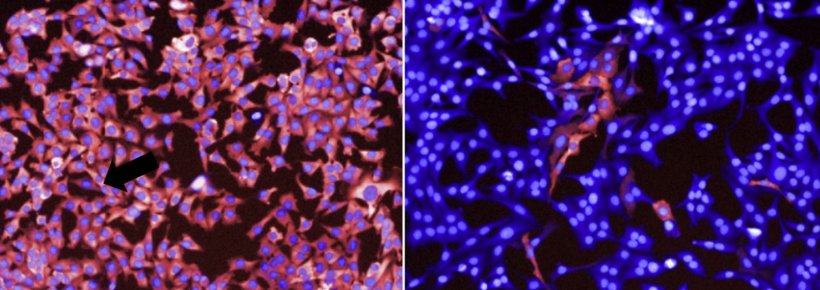 Untreated melanoma cancer cells (left) express pERK (red), a marker of growth....