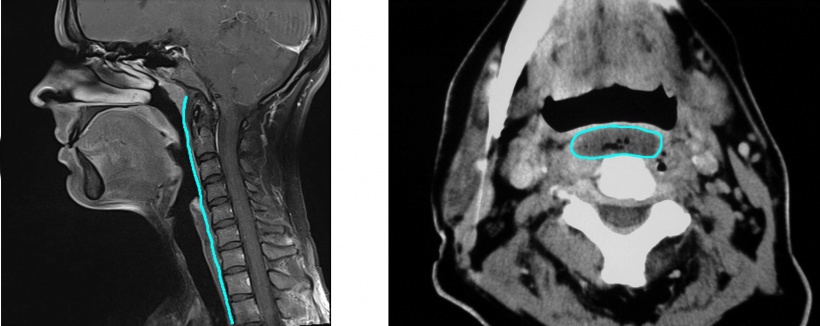Vom Retropharyngealraum (Abb. links, blaue Linie) können sich retropharyngeale...