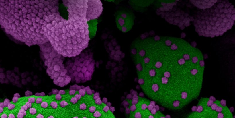Colorized scanning electron micrograph of an apoptotic cell (green) heavily...