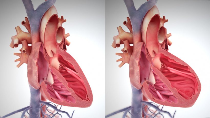 heart failure illustration