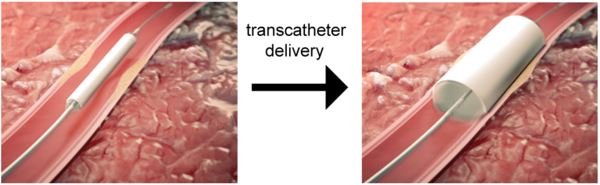 Illustration of transcatheter delivery