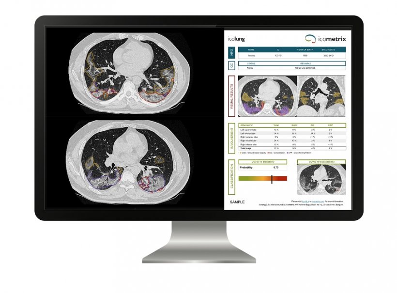 AI lung scan analysis rolled out across Europe