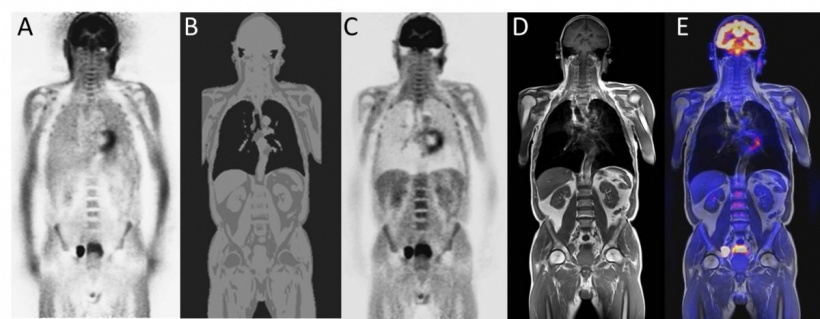 Whole body PET/MR image of a patient with metastases in the pelvic area: (A)...