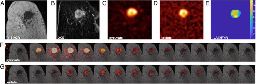 (A,B) Proton and (C-G) carbon-13 MR images from a patient with TNBC (triple...