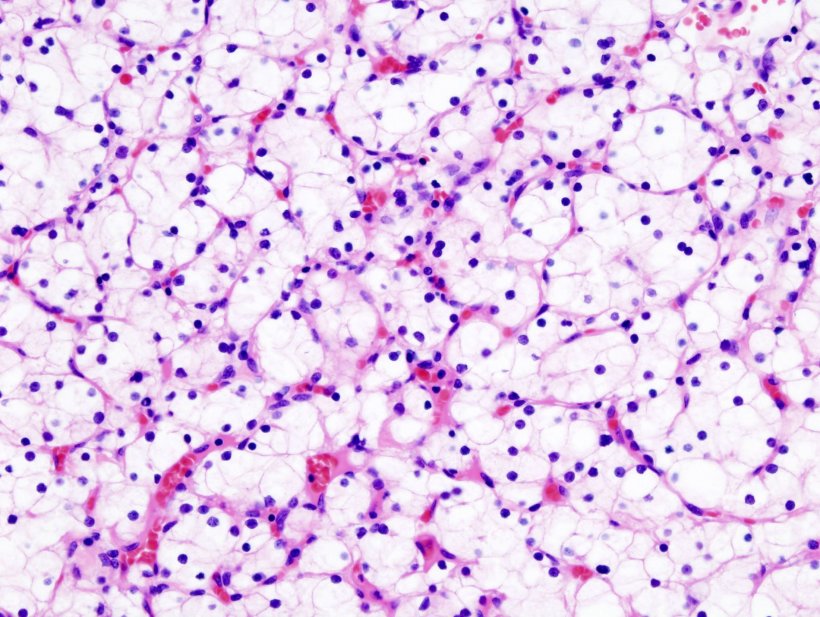 Histopathologische Aufnahme eines klarzelligen Nierenkarzinom: Forscher vom...