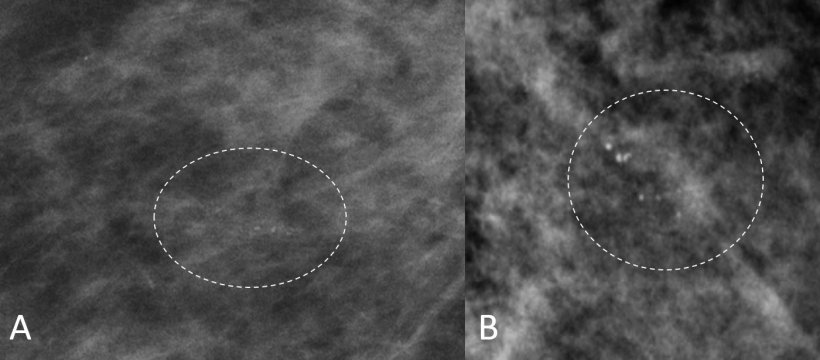 Two cases that underwent stereotactic vacuum-assisted breast biopsy due to...