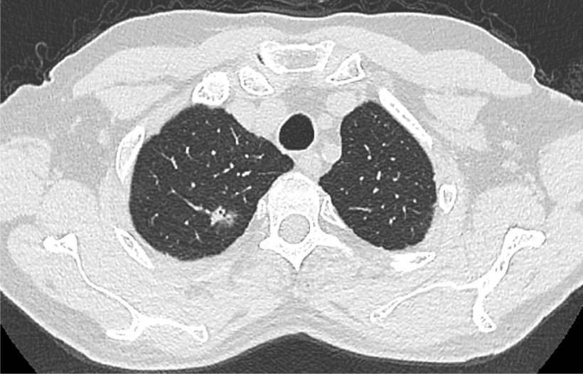 Chest CT: lung cancer in the right upper lobe