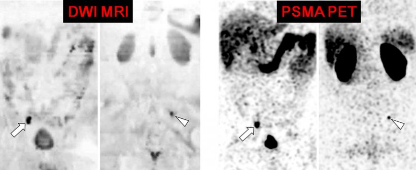 Comparison of diffusion-weighted MRI (left) and PSMA PET (right), both...