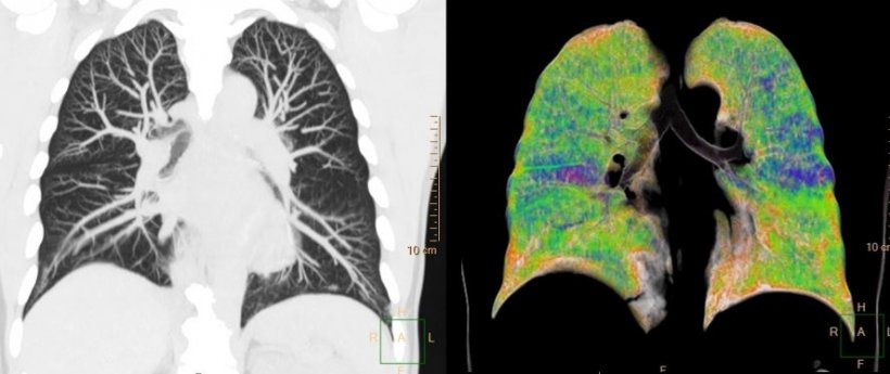 CT chest scan of Covid-19 patient, enhanced with AI tools